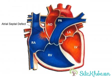 Block nhĩ thất cấp 3 do bệnh lý tim mạch như van tim suy tim gây ra