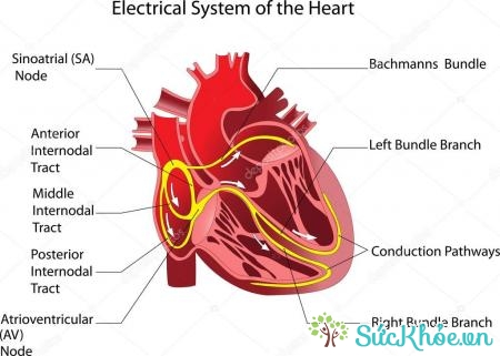 Block nhĩ thất cấp 2 có thể làm tim tắc nghẽn