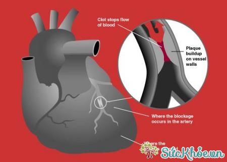Các bệnh lý tim mạch là nguyên nhân gây bệnh block nhĩ thất