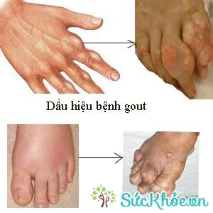 Điều trị bệnh gout bằng thuốc đông y đơn giản hiệu quả