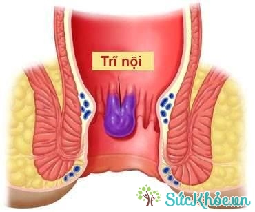 Nguyên nhân gây ra bệnh trĩ nội