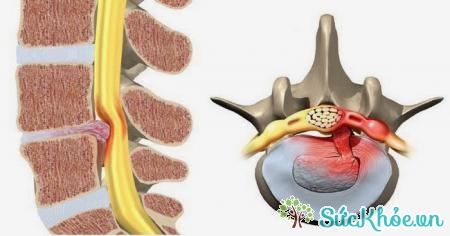 Điều trị thoát vị đĩa đệm cột sống