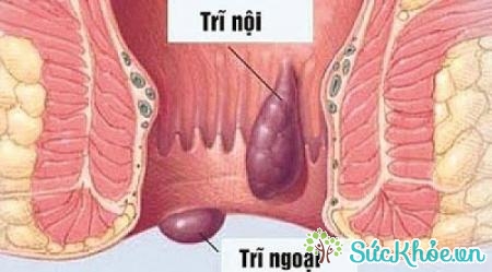 Nguyên nhân gây ra bệnh trĩ nội