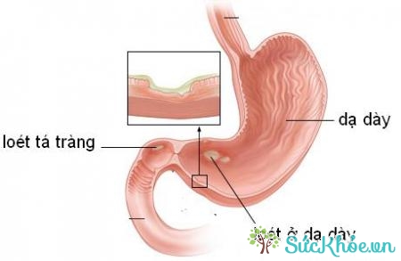 Bệnh viêm dạ dày cấp có nguy hiểm không