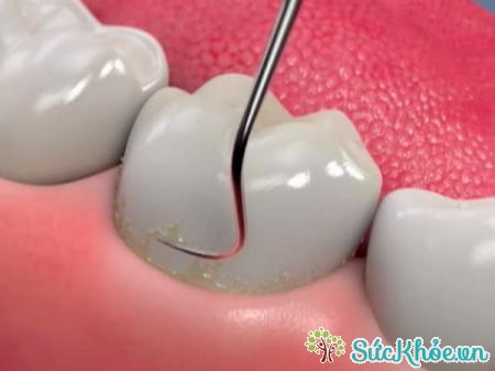 Mòn men răng xảy ra khi lớp men bao phủ răng bị bào mòn