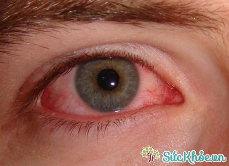 Chữa đau mắt đỏ bằng đông y