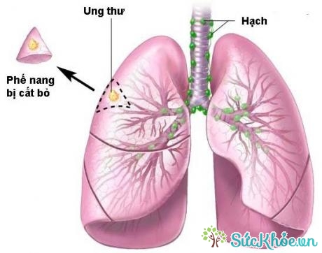 Nguyên nhân gây ra bệnh ung thư phổi