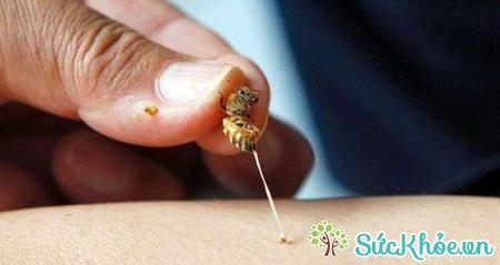 Lấy vòi chích của ong ra bằng cách khều nhẹ hoặc dùng nhíp lấy ra