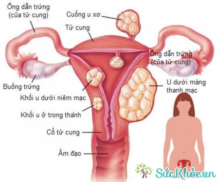Khôi u buồng trứng lành tính gồm u nang chức năng và u bướu
