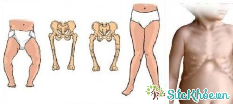 Còi xương gây dị dạng ở trẻ em