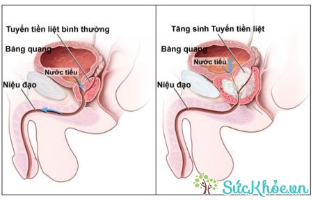 Thuốc điều trị bệnh tuyến tiền liệt