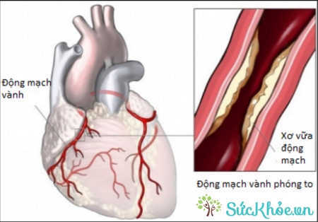 Bệnh tim to hay còn gọi là bệnh cơ tim phì đại