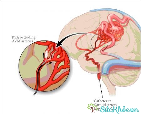 Tụ máu não xảy ra khi một mạch máu não bị vỡ