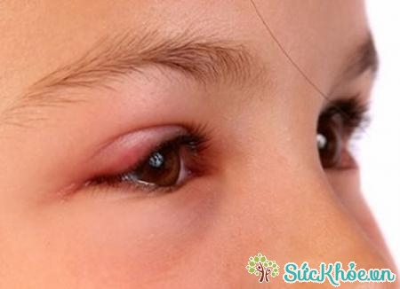 Viêm giác mạc do herpes gây đau nhức mắt