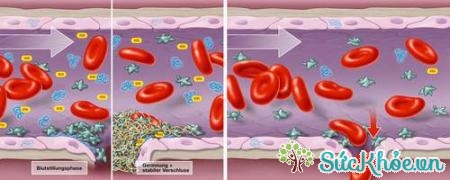 Quá trình đông máu bình thường (trái) và máu không đông trong bệnh von Willebrand (phải).