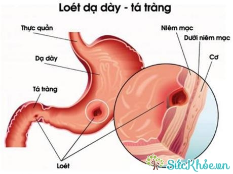 Lô hội có tác dụng với bệnh viêm loét dạ dày - tá tràng.