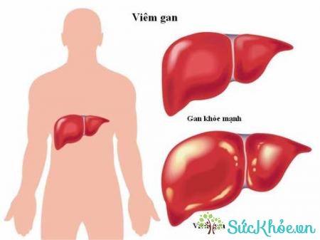 Bệnh nhân xơ gan mấy bù thường vàng da, vàng mắt