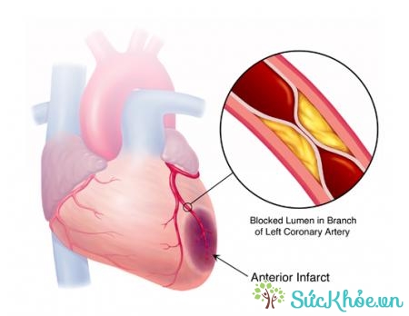 Xơ cữa động mạch vành là nguyên nhân chín dẫn đến các bệnh lý tim mạch