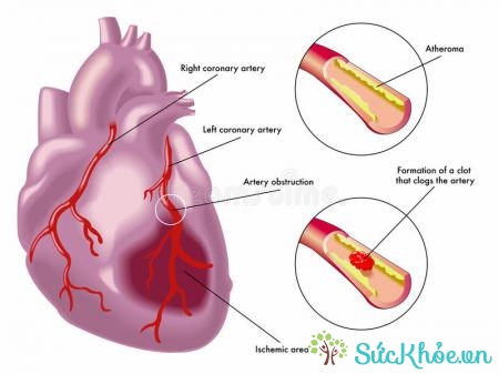Bệnh gây nhiều biến chứng như nhồi máu cơ tim