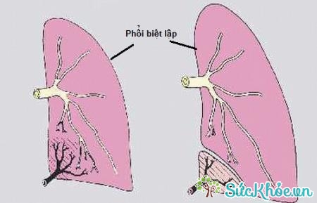Nang phổi bẩm sinh là dị tật ở phổi khá phổ biến với nhiều thể khác nhau