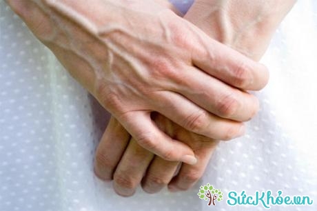 Tĩnh mạch nổi nhiều dưới da tay thường là biểu hiện cho thấy chất thải đọng dưới lưng và eo.