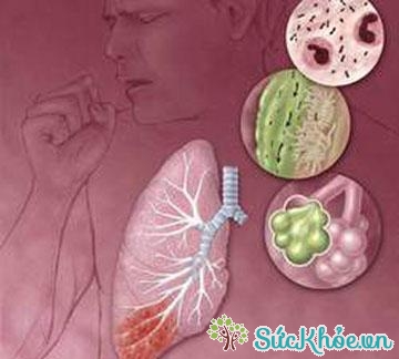 Viêm phổi thường gặp trong mùa xuân do vi khuẩn xâm nhập vào hệ hô hấp.