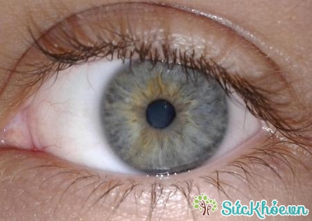 Mộng mắt có thể xảy ra ở hai mắt và có khối trắng phát triển
