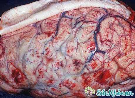 Viêm màng não do mô cầu lây qua đường hô hấp và có thể lây nhiễm qua tiếp xúc với bàn tay, vật dụng cá nhân bị nhiễm vi khuẩn từ bệnh phẩm của bệnh nhân.