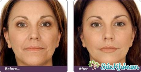 Khuôn mặt trước và sau khi tiêm botox. 