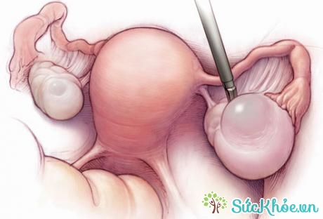 U nang buồng trứng có thể được phát hiện bằng khám phụ khoa hoặc siêu âm