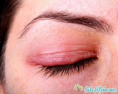 Một trong những nguyên nhân sưng phù mí mắt, lên lẹo và đau mắt đỏ lại là từ việc dùng chung các sản phẩm trang điểm mắt 
