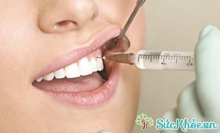 Mục đích chữa tủy răng là lấy hết tủy bị viêm ra khỏi ống tủy và hàn trám bù