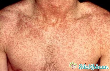 Tổn thương da trong bệnh Rubella 