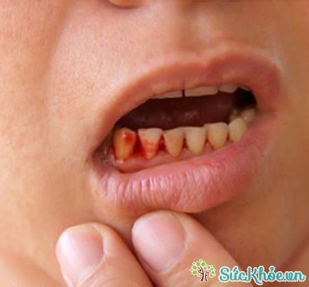 Nguyên nhân gây viêm chân răng do răng mọc lệch