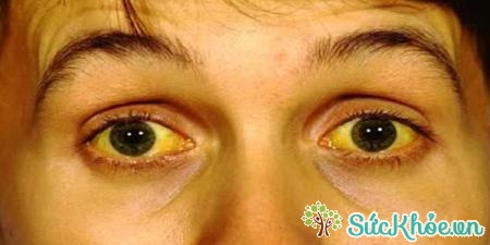 Bệnh nhân mắc hội chứng hoàng đản có dấu hiệu vàng da, vàng mắt