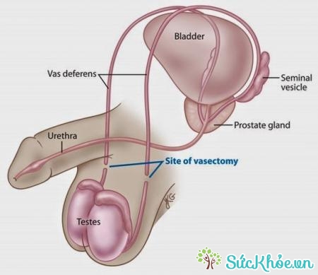 Phẫu thuật thắt ống dẫn tinh là biện pháp phòng tránh mang thai ngoài ý muốn, áp dụng cho nam giới
