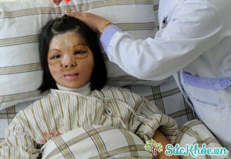 Khuôn mặt bệnh nhân Xu Jianmei trong quá trình phẫu thuật chỉnh sửa.