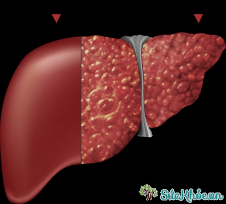 Xơ hóa gan là sự tích tụ nhiều mô sẹo
