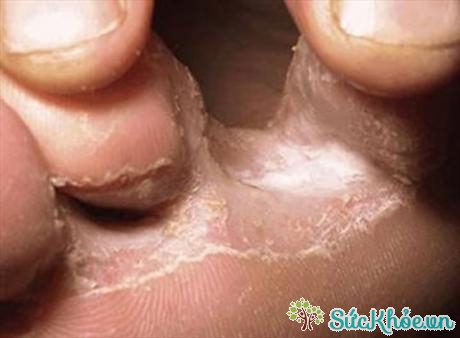 Bàn chân dễ bị nấm do thường xuyên phải tiếp xúc với nước