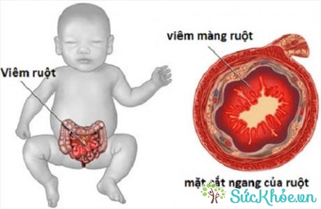 Viêm ruột hoại tử cấp tính ở trẻ em