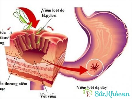 Hình ảnh vi khuẩn H.Pylori trong dạ dày.
