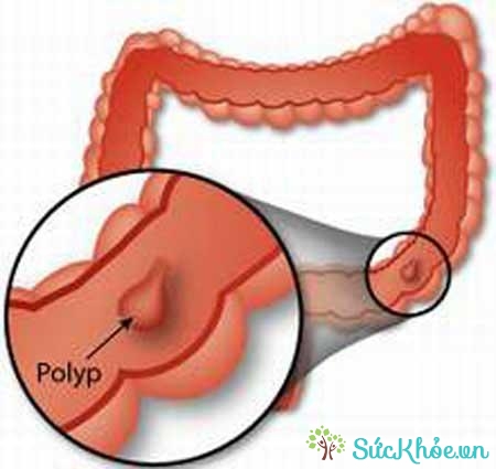 Bệnh polyp hậu môn do nhiều nguyên nhân như thói quen ăn uống gây ra