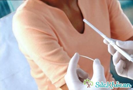 Cấy que tránh thai là phương pháp cấy dưới da một hoặc nhiều que nhỏ có chứa hoóc-môn progesterone