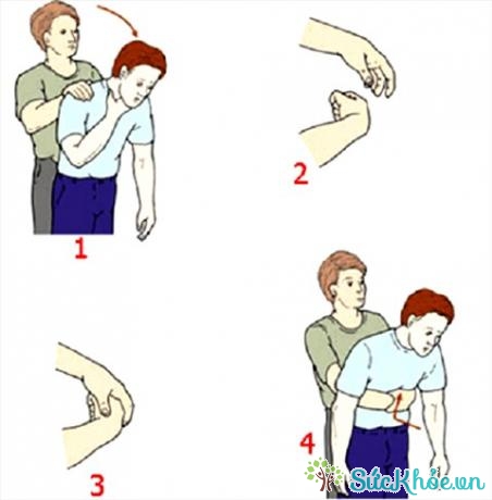 Phương pháp đẩy bụng (còn được gọi là Heimlich maneuver)