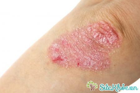Eczema là tình trạng da thay đổi do viêm