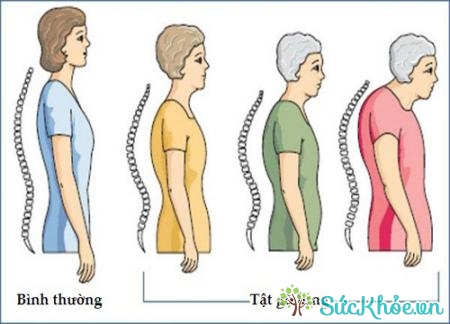 Gù lưng là rối loạn phát triển cột sống gây mất thẩm mỹ