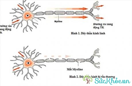 Trong bệnh lý này, hệ thống miễn dịch trực tiếp chống lại các dây thần kinh ngoại biên, thường nhất là dây thần kinh có bao myelin.