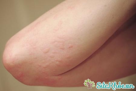 Mẩn ngứa là triệu chứng cơ năng của nhiều bệnh như bênh ngoài da
