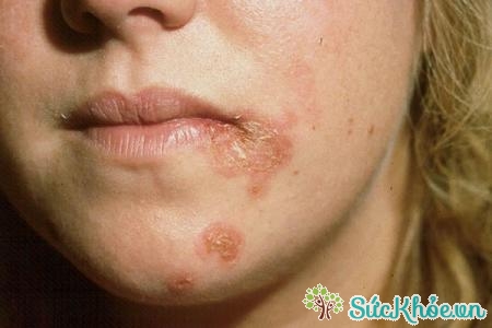 Bệnh zola là một bệnh nhiễm trùng do 1 loại virus gây ra