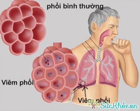 Hình ảnh bệnh viêm phổi